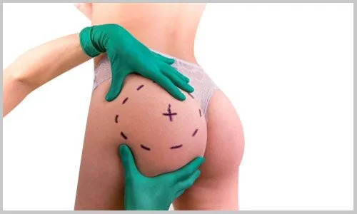 AUGMENTATION-DES-FESSES