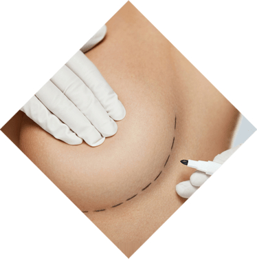 lipofilling-mammaire